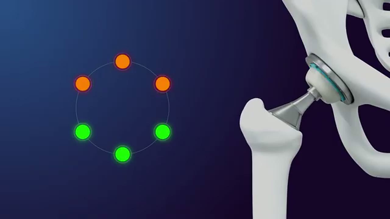 Hip implant and sensing liner from the original ArtioSense film