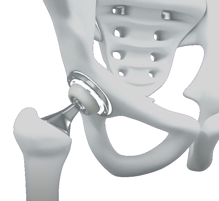 ArtioSense's hip implant illustration, showing the ball and socket joint